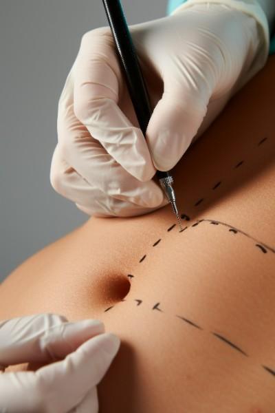 abdominoplastie