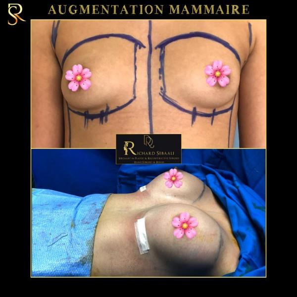 Chirurgie esthétique des seins